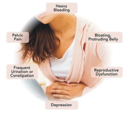 uterine-fibroids