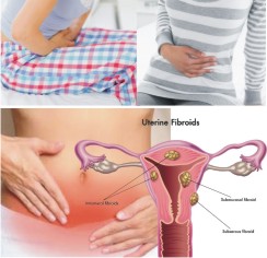 uterine-fibroids