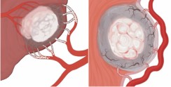 uterine-fibroids