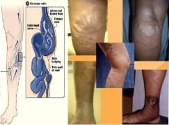 varicose veins