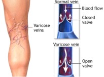 varicose veins