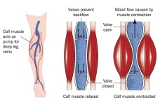 varicose veins