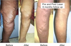 varicose veins